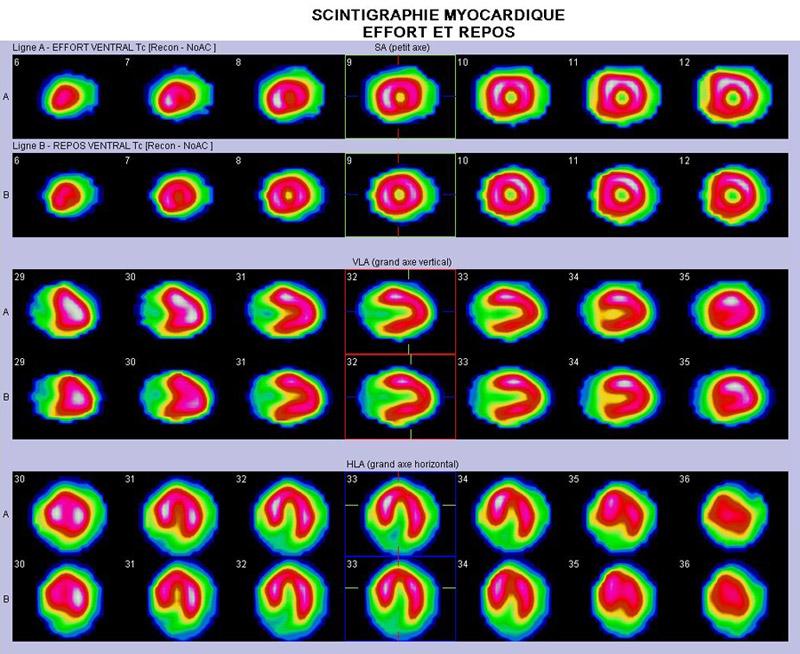 Scintigraphie myocardique