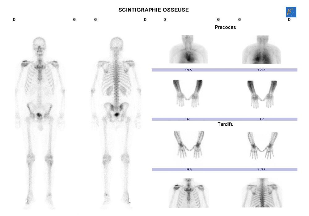 Scintigraphie osseuse