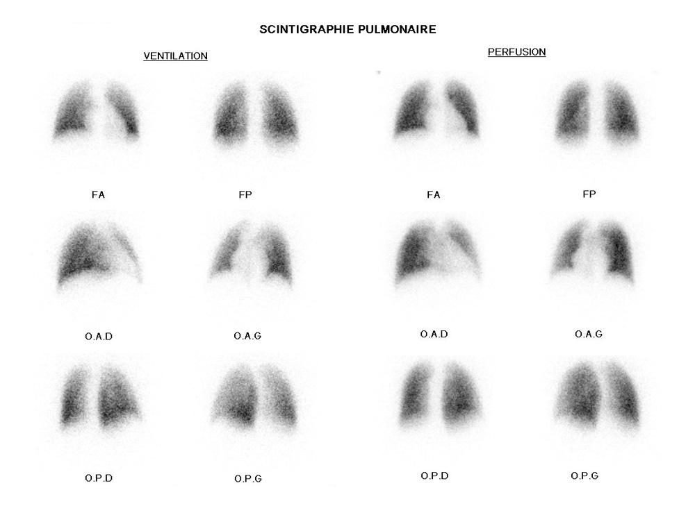 Scintigraphie pulmonaire