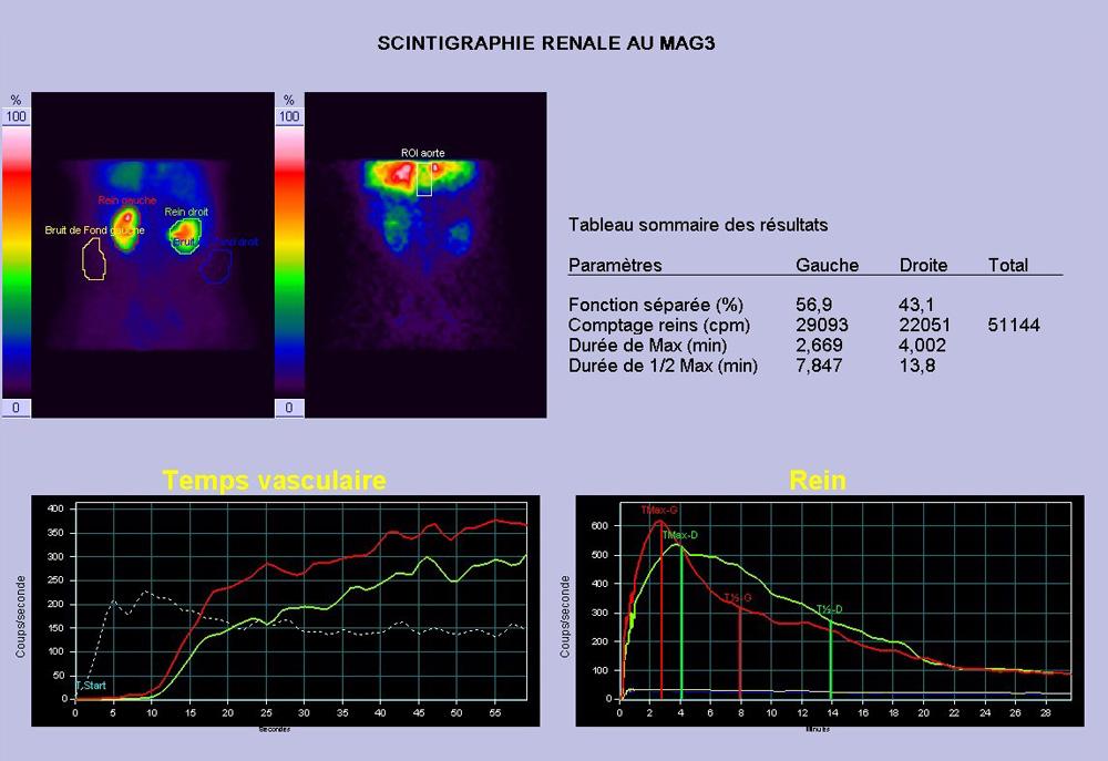 La scintigraphie rénale