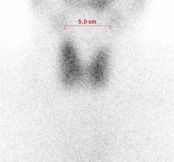 Scintigraphie thyroidienne